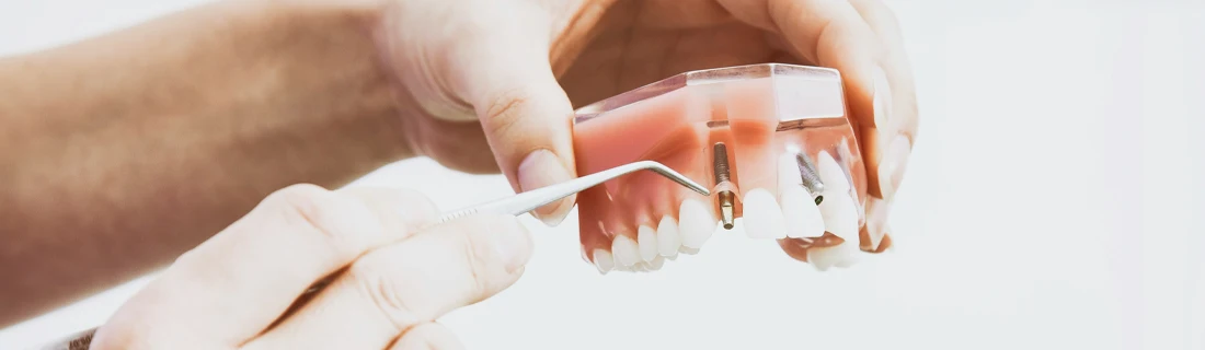 Dental Implants at Saunders Krog Dental in Fargo ND